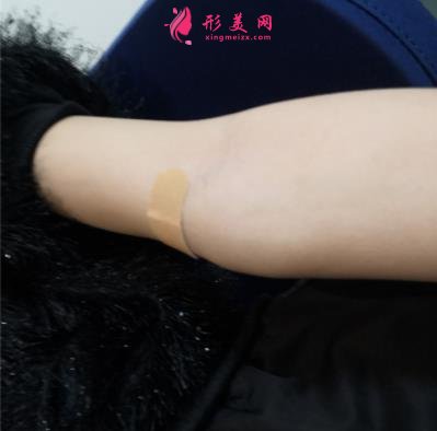 河北工程大學(xué)附屬醫(yī)院整形外科手臂抽脂案例分享！含吸脂價格表公開
