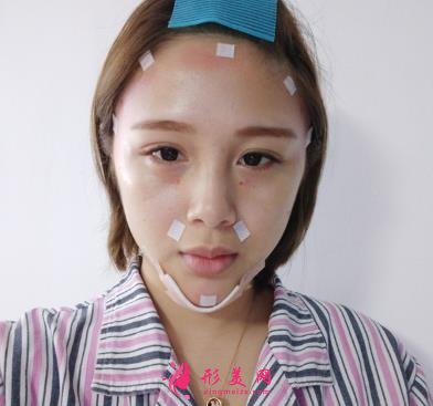 秦皇島市中醫(yī)院醫(yī)學(xué)美容科自體脂肪全臉填充案例一覽！含全新價(jià)格表展示