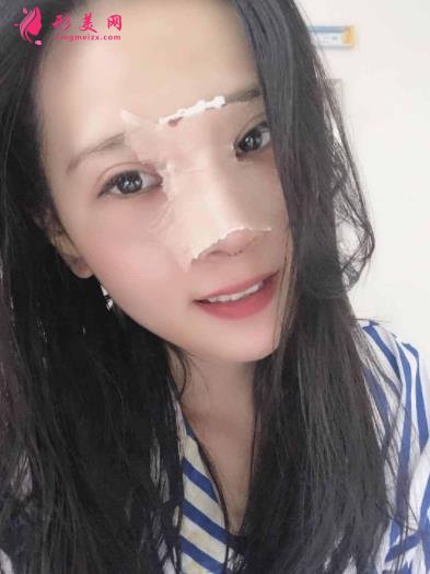 南陽市中心醫(yī)院整形怎么樣？隆鼻案例效果反饋圖及新版價格表正式公開