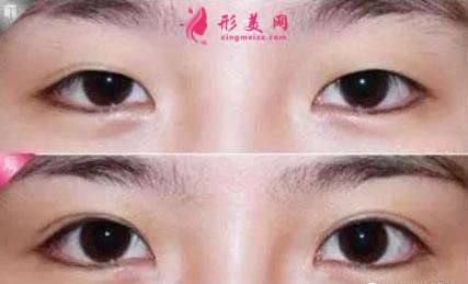 西安開眼角哪個(gè)醫(yī)院好？西安藝星怎么樣？手術(shù)優(yōu)勢(shì)及價(jià)格參考