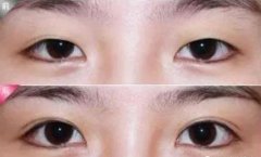 西安開眼角哪個(gè)醫(yī)院好？西安藝星怎么樣？手術(shù)優(yōu)勢(shì)及價(jià)格參考