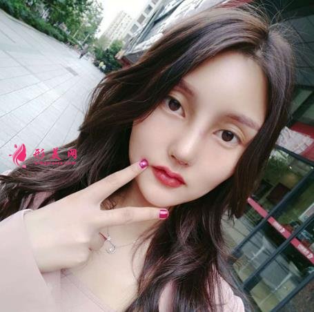 鄭州華領(lǐng)朱志娟隆鼻效果好嗎？真人案例對比圖新曝光一覽