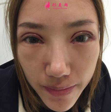深圳市第二人民醫(yī)院整形科怎么樣？雙眼皮多少錢？附案例欣賞
