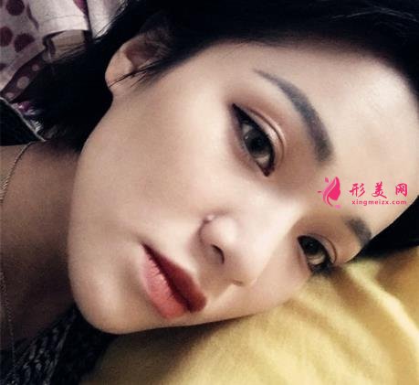 嘉興第一人民醫(yī)院整形科怎么樣?做雙眼皮案例效果圖和價(jià)格表展示