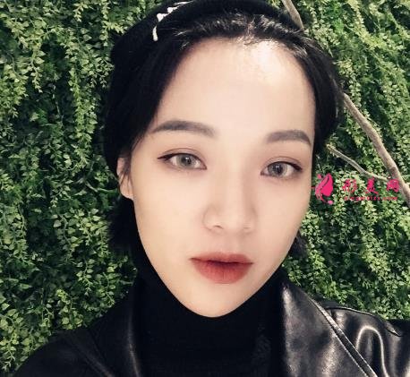 嘉興第一人民醫(yī)院整形科怎么樣?做雙眼皮案例效果圖和價(jià)格表展示