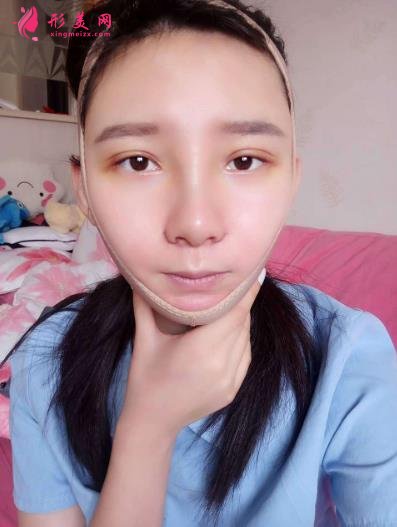武漢同濟(jì)整形科怎么樣？做磨骨口碑案例~~恢復(fù)照片記錄反饋