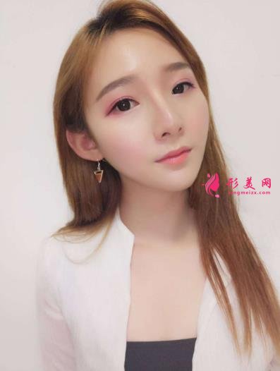 武漢同濟(jì)整形科怎么樣？做磨骨口碑案例~~恢復(fù)照片記錄反饋