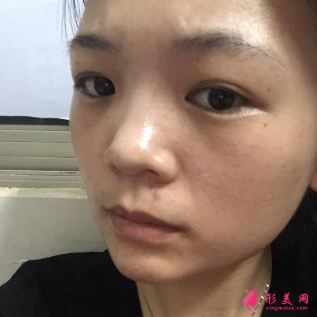 浙江省中醫(yī)院車菲掛號容易嗎?去眼袋多少錢？附案例參考