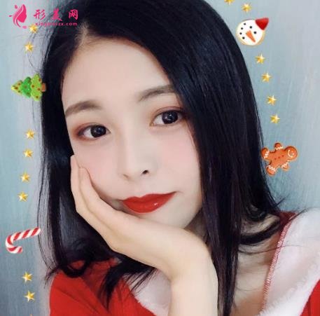 成都顴骨內(nèi)推哪家醫(yī)院好?成都友誼醫(yī)院90天恢復(fù)案例給你參考
