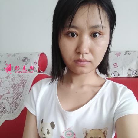 延安市人民醫(yī)院整形科怎么樣？2021雙眼皮手術(shù)恢復過程圖分享
