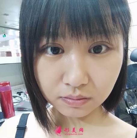 延安市人民醫(yī)院整形科怎么樣？2021雙眼皮手術(shù)恢復過程圖分享