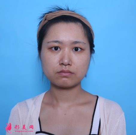 延安市人民醫(yī)院整形科怎么樣？2021雙眼皮手術(shù)恢復過程圖分享