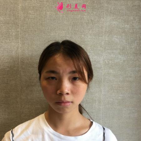 北京電力醫(yī)院整形中心價(jià)格表及雙眼皮手術(shù)恢復(fù)過程分享