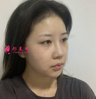 北京協(xié)和醫(yī)院整形科割雙眼皮怎么樣?案例效果和價(jià)格表費(fèi)用分享