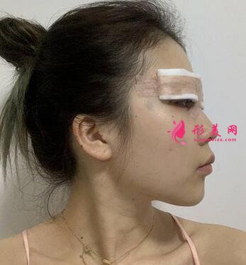 北京協(xié)和醫(yī)院整形科割雙眼皮怎么樣?案例效果和價(jià)格表費(fèi)用分享