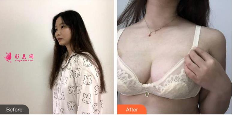 攀枝花第五人民醫(yī)院整形美容科做雙眼皮咋樣?效果和價(jià)格表上線!