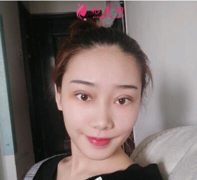 滄州市中心醫(yī)院整形美容割雙眼皮價(jià)格|真實(shí)案例及醫(yī)生名單分享