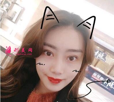 滄州市中心醫(yī)院整形美容割雙眼皮價(jià)格|真實(shí)案例及醫(yī)生名單分享