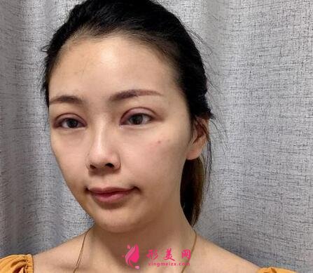 包頭第四醫(yī)院整形美容科怎么樣？價格表|雙眼皮案例一覽