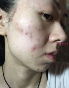 新生質(zhì)感美膚_祛除疤痕—有效祛疤恢復(fù)質(zhì)感皮膚
