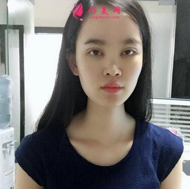重慶市中山醫(yī)院整形美容科價(jià)格表，附隆鼻案例效果對(duì)比圖