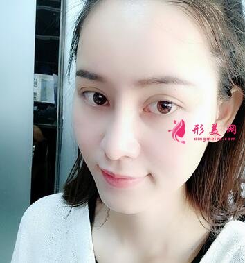 重慶市中山醫(yī)院整形美容科價(jià)格表，附隆鼻案例效果對(duì)比圖
