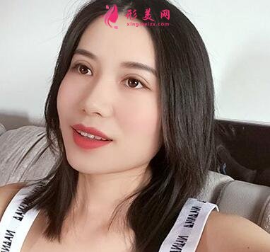 廣州中科美整形醫(yī)院價格表費用和雙眼皮效果對比圖分享~