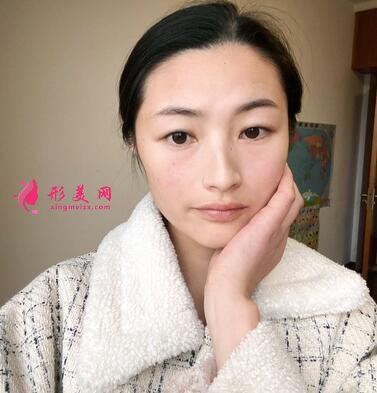 邯鄲市第四醫(yī)院整形科價(jià)格表收費(fèi)|雙眼皮案例圖賞析~