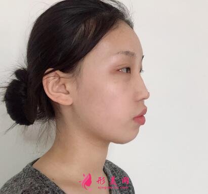 深圳市人民醫(yī)院整形美容科價格表隆鼻整形案例分享