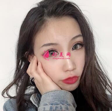 深圳市人民醫(yī)院整形美容科價格表隆鼻整形案例分享