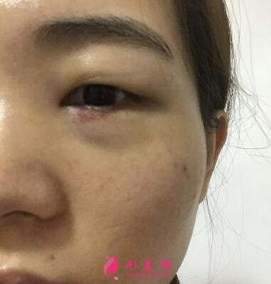 浙江省中醫(yī)院整形科去眼袋怎么樣？?jī)r(jià)格表|簡(jiǎn)介|案例效果多圖反饋