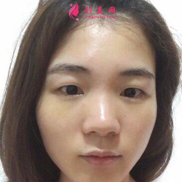 浙江省中醫(yī)院整形科去眼袋怎么樣？?jī)r(jià)格表|簡(jiǎn)介|案例效果多圖反饋