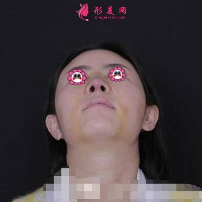 鄭大一附院整形外科隆鼻咋樣?案例效果和價格費用一覽