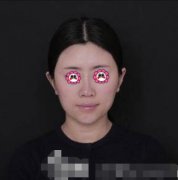 鄭大一附院整形外科隆鼻咋樣?案例效果和價(jià)格費(fèi)用一覽