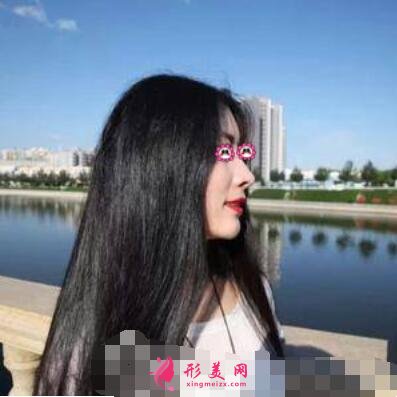 鄭大一附院整形外科隆鼻咋樣?案例效果和價格費用一覽