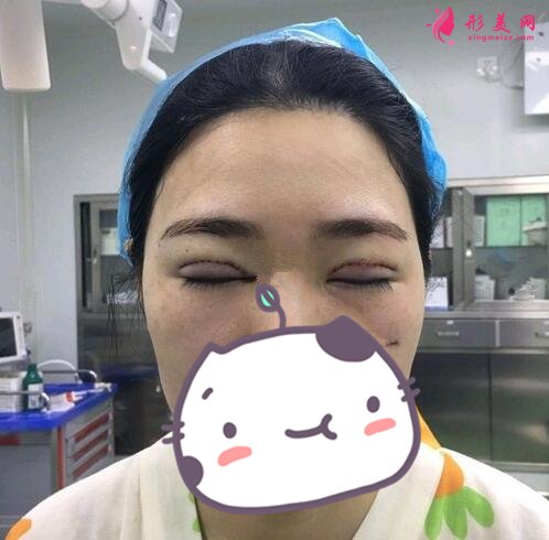 河北友愛(ài)醫(yī)院整形美容科何靜做雙眼皮案例價(jià)格表收費(fèi)一覽