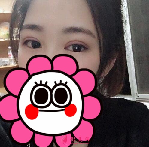 河北友愛(ài)醫(yī)院整形美容科何靜做雙眼皮案例價(jià)格表收費(fèi)一覽