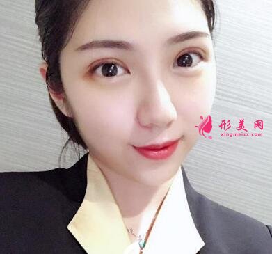 義烏張小紅整形醫(yī)院雙眼皮價(jià)格表2020+真人案例效果圖展示