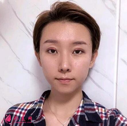 河北省二院整形美容科張卓男雙眼皮案例術(shù)后恢復效果圖展示【實拍】