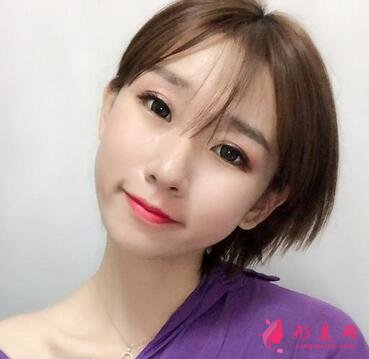 河北省二院整形美容科張卓男雙眼皮案例術(shù)后恢復效果圖展示【實拍】