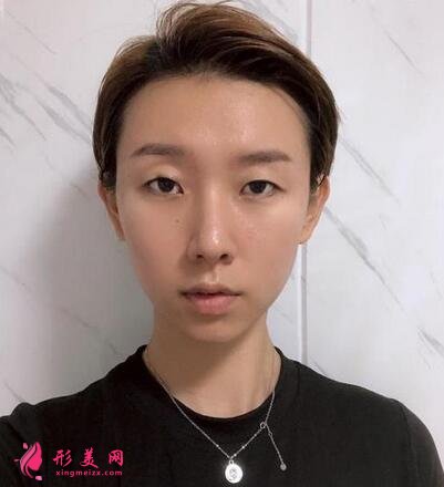 河北省二院整形美容科張卓男雙眼皮案例術(shù)后恢復效果圖展示【實拍】