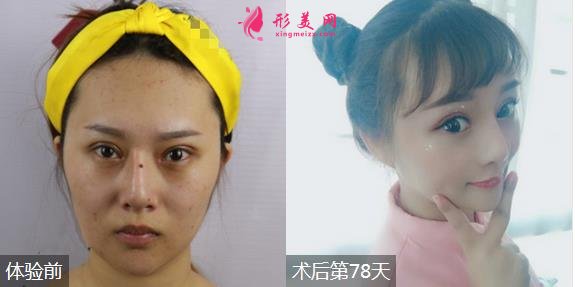 天津醫(yī)科大學(xué)眼科醫(yī)院整形科簡介/2020價(jià)格表大全/效果圖反饋