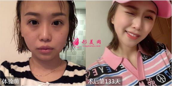 天津醫(yī)科大學(xué)眼科醫(yī)院整形科簡介/2020價(jià)格表大全/效果圖反饋
