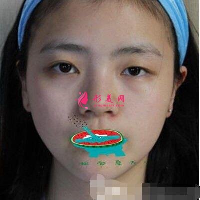 咸陽長城整形美容醫(yī)院怎么樣?價格表|雙眼皮案例分享