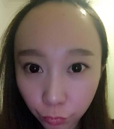廣州倍生女性發(fā)際線調整案例