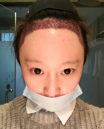 廣州倍生女性發(fā)際線調整案例