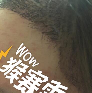 廣州倍生女性發(fā)際線調整案例