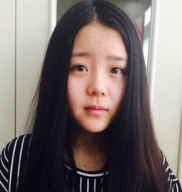 鼻綜合整形案例和恢復(fù)過程圖分享——寧波尚美整形美容醫(yī)院