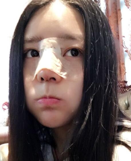 鼻綜合整形案例和恢復(fù)過程圖分享——寧波尚美整形美容醫(yī)院