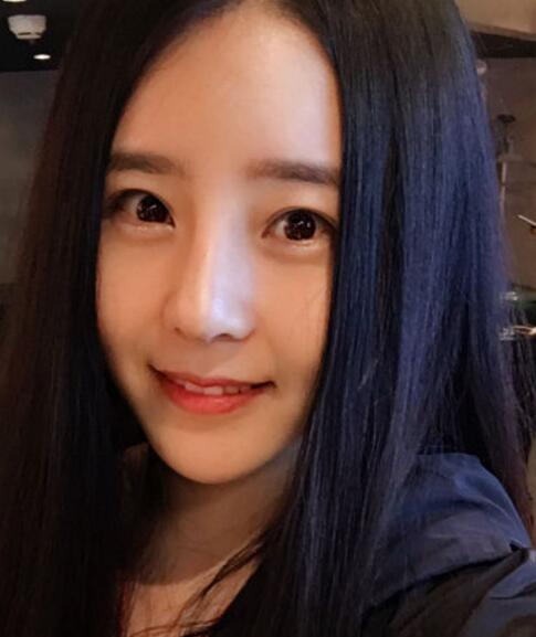 鼻綜合整形案例和恢復(fù)過程圖分享——寧波尚美整形美容醫(yī)院